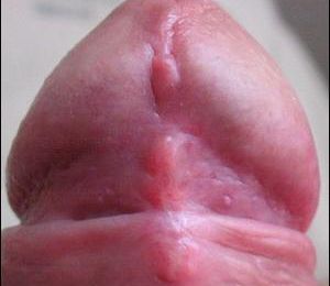 penile papule #11