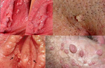 Hasil gambar untuk penyakit kutil kelamin